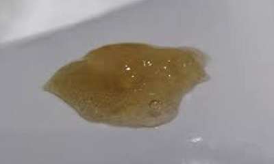 Выделения из носа