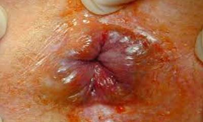 Геморрой у грудничка