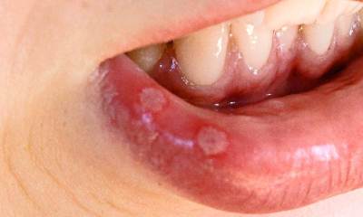 Герпетический стоматит