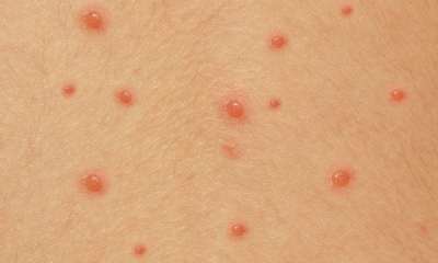 Как выглядит ветрянка у взрослых