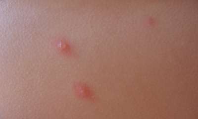 Как выглядит ветрянка