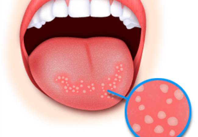 Как выглядит стоматит
