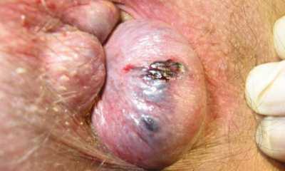 Как проявляется геморрой