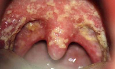 Кандидозный стоматит