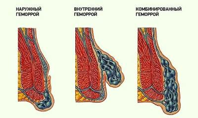 Комбинированный геморрой