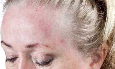 Контактный дерматит на лице