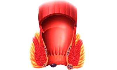 Наружный геморрой