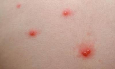 Начало ветрянки