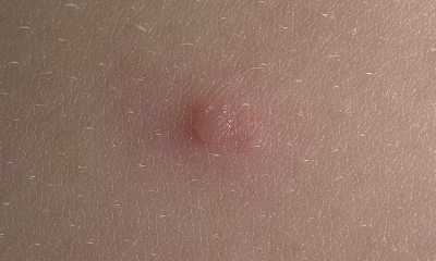 Начальная стадия ветрянки