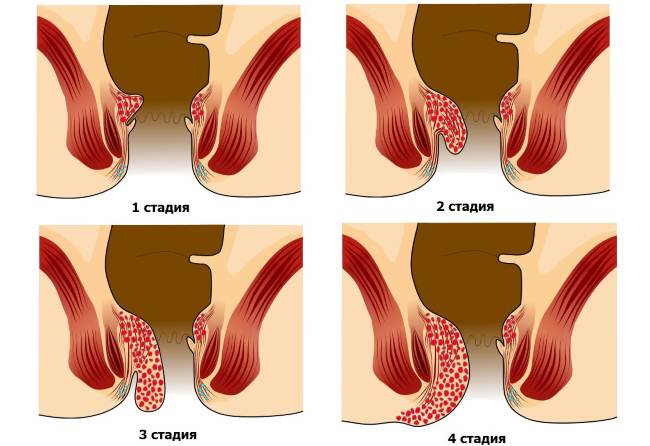 Начальная стадия геморроя