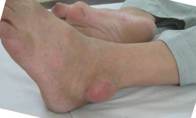 Подагра голеностопного сустава