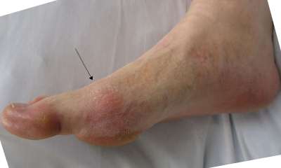 Подагра стопы