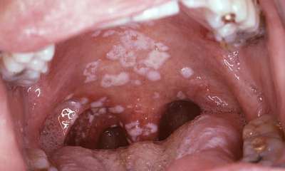 Признаки стоматита у взрослых