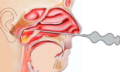 Прокол при гайморите