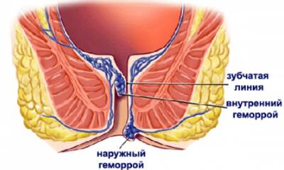 Разновидности геморроя