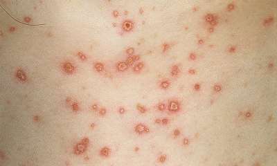 Симптомы ветрянки у взрослых