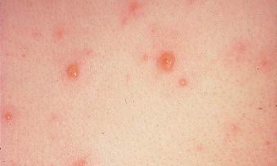 Симптомы ветрянки у детей