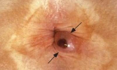 Симптомы геморроя у детей