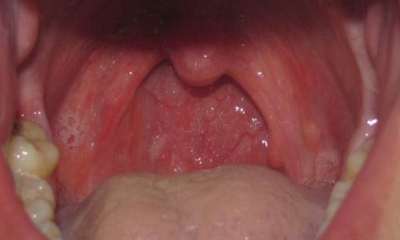 Стоматит на горле