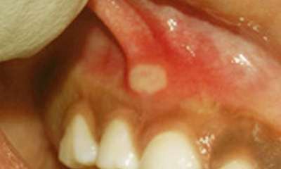 Стоматит на десне