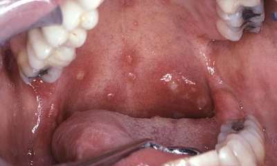 Стоматит на небе