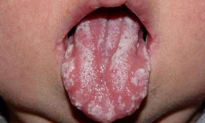 Стоматит на языке
