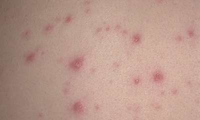 Сыпь при ветрянке