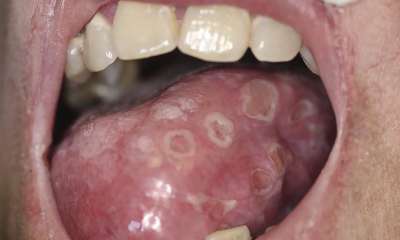 Язвенный стоматит