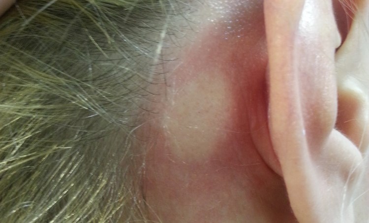 Аллергия на краску для волос