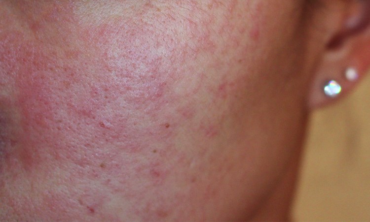 Аллергия на крем для лица