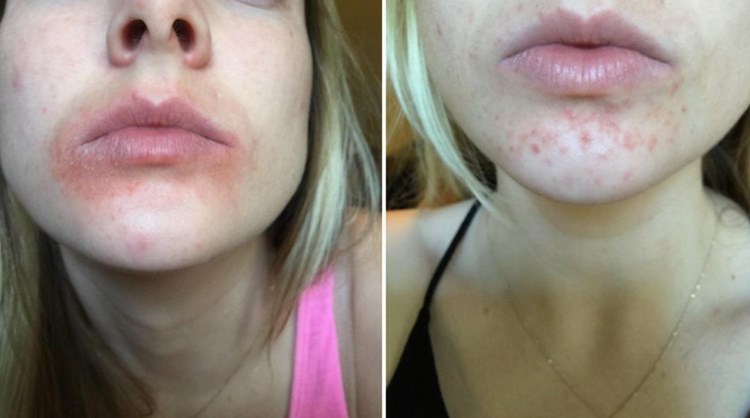 Аллергия на помаду