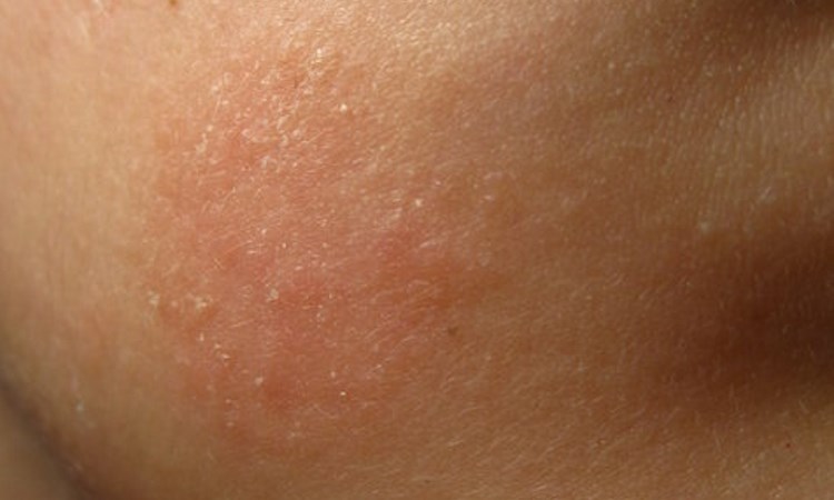 Аллергия на пудру