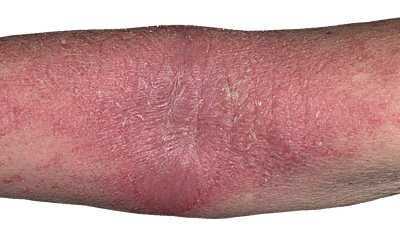 Атопический дерматит на руках
