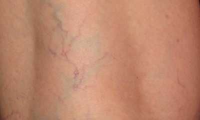 Варикоз в начальной стадии