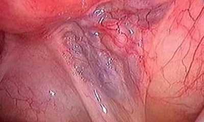 Варикоз матки