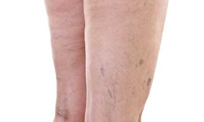 Варикоз на ногах