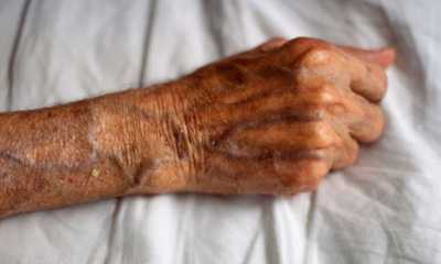 Варикоз на руках