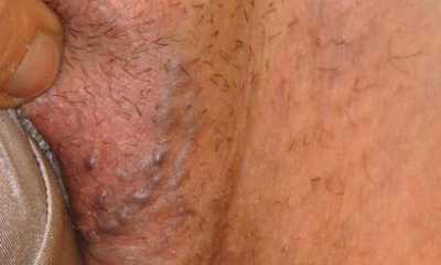 Варикоз половых губ