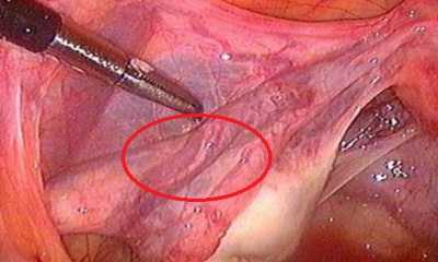 Варикозное расширение вен малого таза