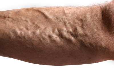 Варикозное расширение вен на ногах