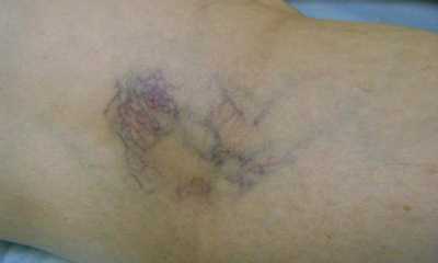 Варикозное расширение вен на руках