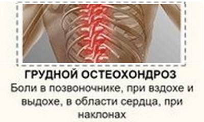 Грудной остеохондроз