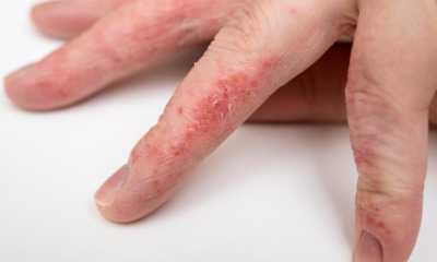 Дерматит на пальцах рук