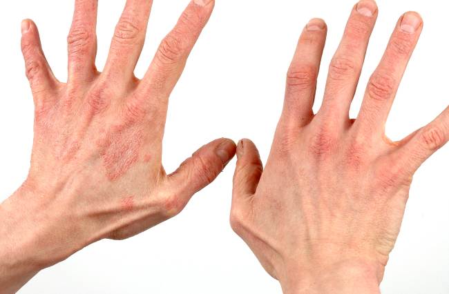 Дерматит на руках