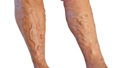 Как выглядит варикозное расширение вен