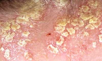 Как выглядит себорейный дерматит