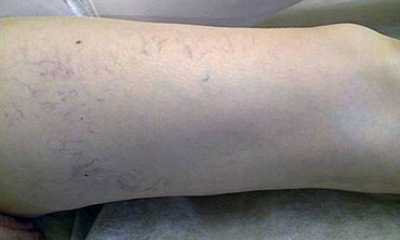 Начальная стадия варикозного расширения вен