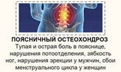 Остеохондроз поясничного отдела