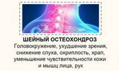 Остеохондроз шейного отдела