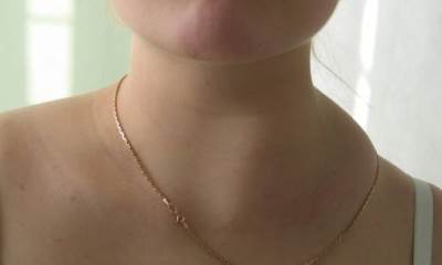 Припухлость над ключицей